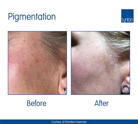 IPL Pigmentation Treatment - Laser for Skin Pigmentation