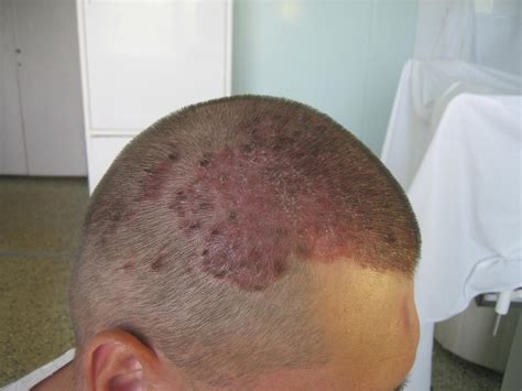 Signs Of Scalp Psoriasis
