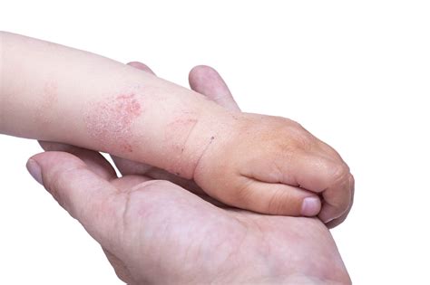 Dermatite atopica (eczema) - Amico Pediatra