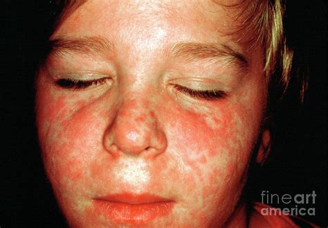 Measles Rash Photograph by Cnri/science Photo Library | Fine Art America