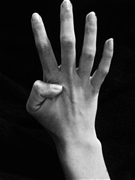 double jointed? o; : r/medical