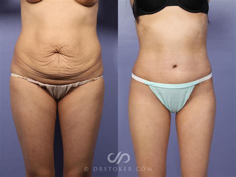 Tummy Tuck Transformation: Before And After Results - Before After