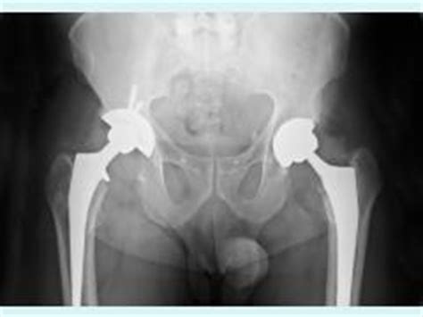 Coxarthrosis