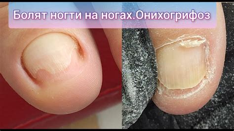 БОЛЯТ НОГТИ НА НОГАХ. ОНИХОГРИФОЗ И ОНИХОЛИЗИС. ТОЛСТЫЙ НОГОТЬ НА ...