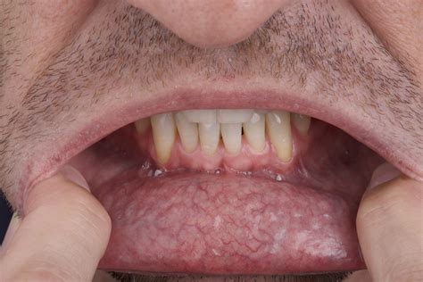 Symptoms Of Mouth Cancer Pictures - Infoupdate.org