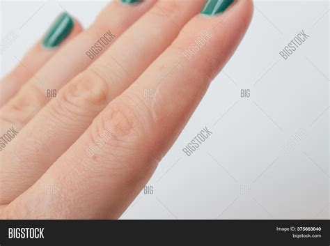Scar On Finger Man On Image & Photo (Free Trial) | Bigstock