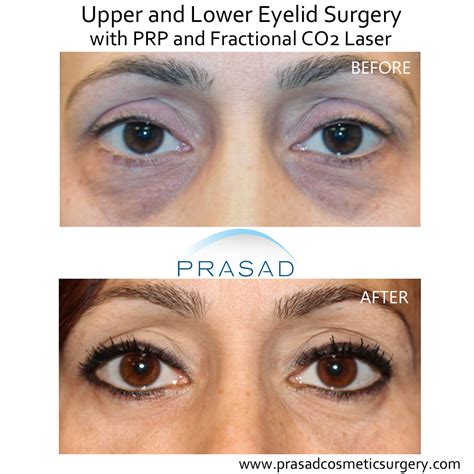 dark circles laser treatment cost  bangalore  robert gump blog
