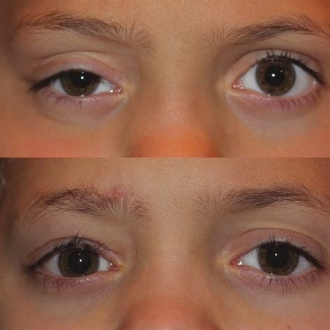 autogenous fascia lata sling ptosis repair  harvesting fascia lata