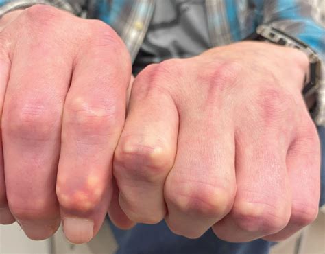 osteoarthritis bumps  finger joints witdx