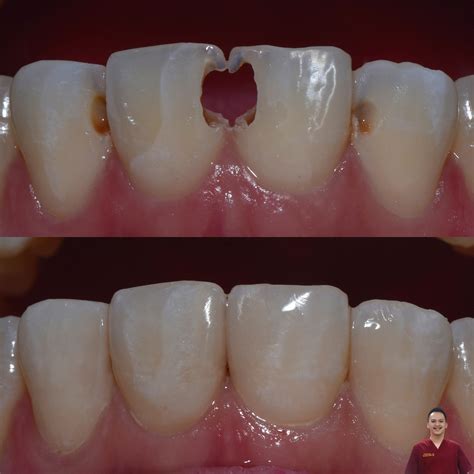 Penambalan Gigi - Janji Dental