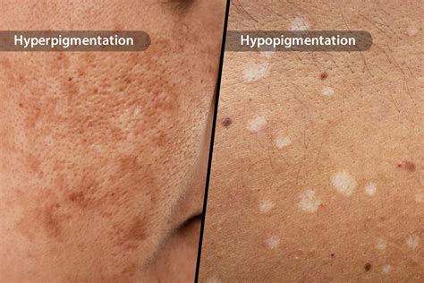 hypopigmentation face white scar treatment treatment
