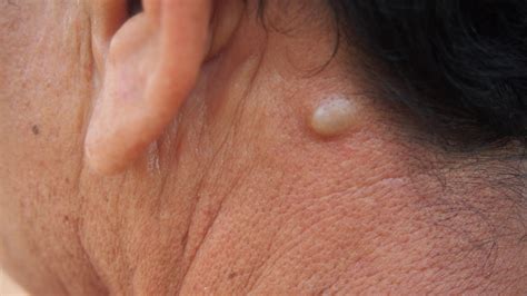 [DIAGRAM] Diagram Of Sebaceous Cyst - MYDIAGRAM.ONLINE