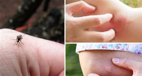 Какая муха меня укусила: как распознать укусы насекомых на даче и что ...