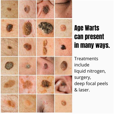 age wart types  warts warts facial warts