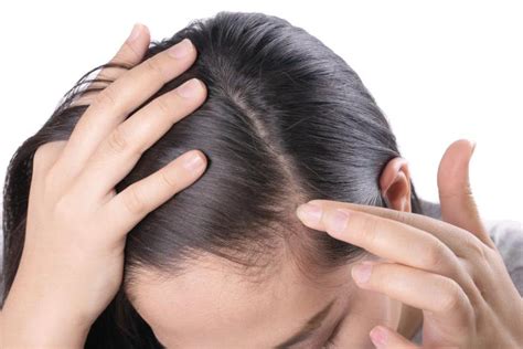 Hairline Acne: Meaning, Reasons, Areas & Solutions