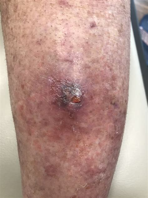 Early Pyoderma Gangrenosum