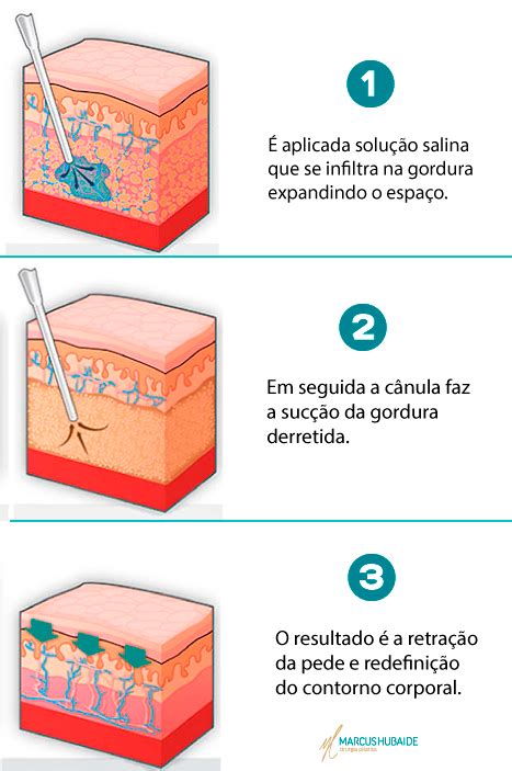 Como É Feito A Lipoaspiração - Lipoaspiração e Segurança – Entendendo como ela acontece | Dr. Marcus ...