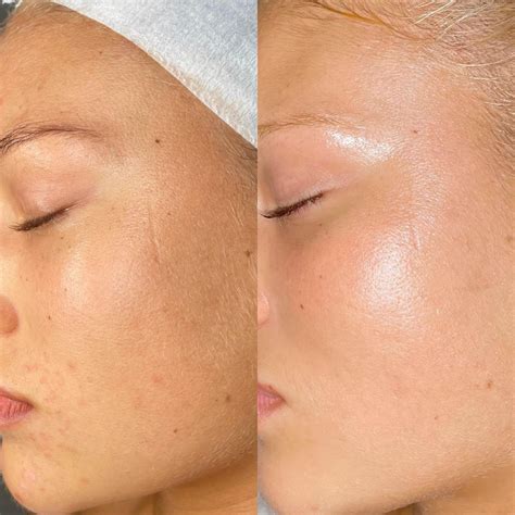 PRP Facial Brisbane | Rejuvenate Your Skin — Glo Haus Brisbane