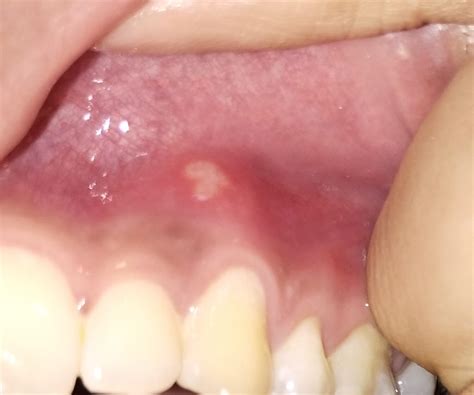 Painful white spots on gums : r/DentalHygiene