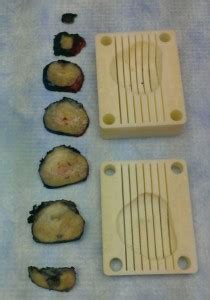 The Use of 3D Printed Prostate Molds Derived From MRI - Sperling Prostate Center