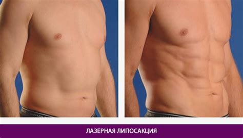 Липосакция в Киеве. Цена на липосакцию живота.