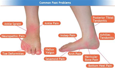 foot pain  feet pain