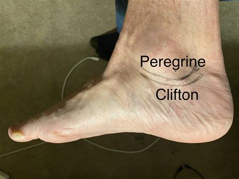 Why are trail shoes cut higher on the ankles? They end up hurting after