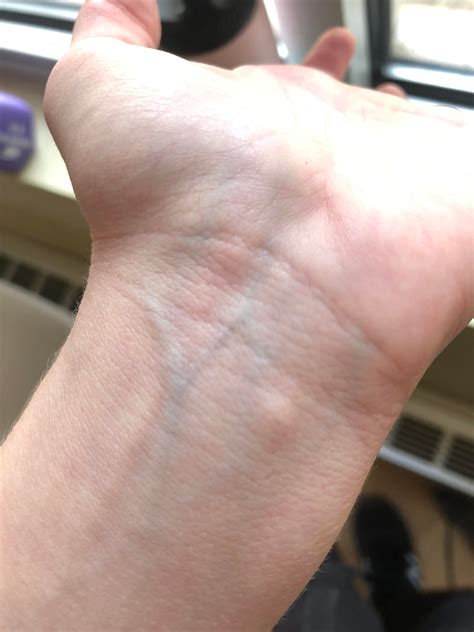 Bumps on inside of wrist : r/ehlersdanlos