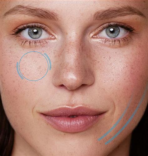 endolift  surgical facelift  surgical procedures aa ent