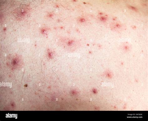 acne pustules close    mans upper   shoulder area