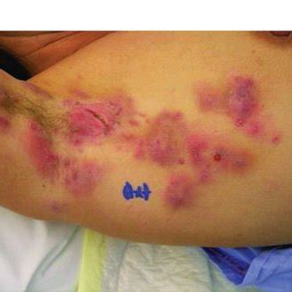 typical clinical   active hidradenitis suppurativa hs