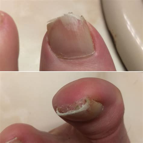 What is going on here? Keratin? Fungus? : r/NailFungus
