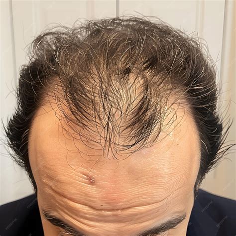 Treatment for Hair Loss Male getting a hair loss treatment Man with