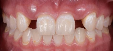 solutions  congenitally missing lateral incisors spear education
