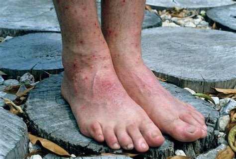 how to cure chigger bites 2
