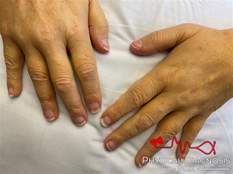terrys nails physical diagnosis pdx