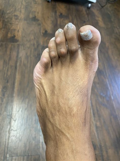 Hammertoe and Corns: Diagnosis and Treatment in Brooklyn | NYC