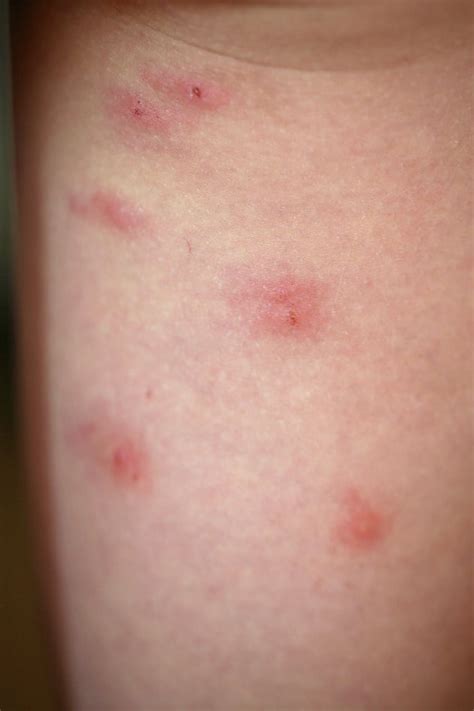 47 Ways to Prevent and Treat Chigger Bites - Lady Lee's Home