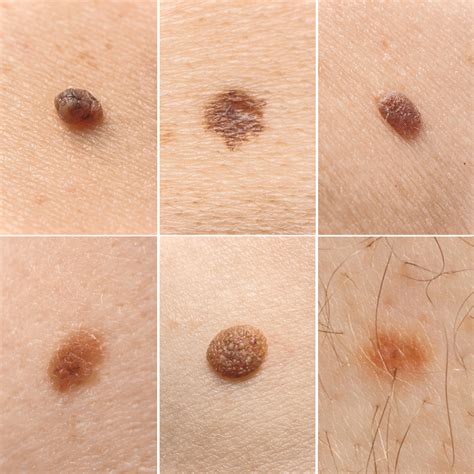 Understanding the different types of moles | Spot Check Clinic