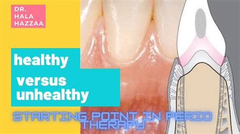 starting point  perio therapy  youtube