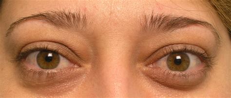 Protruding Eye Shape