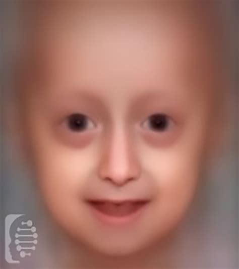 Hutchinson Gilford Progeria Syndrome