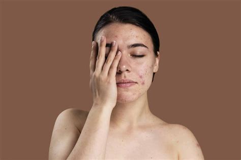 Can Dry Skin Cause Acne? - HealthxTips