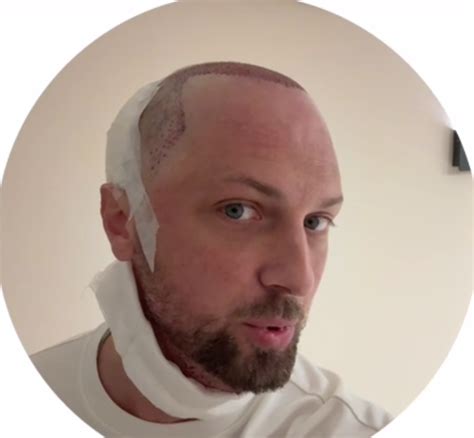 Блогер Александр Зубарев сделал пересадку волос. Работу раскритиковали ...