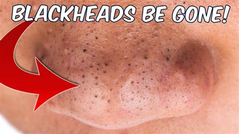 Unbelievable Blackhead Removal 2024: Get Clear Skin FAST! - 3zybxzu