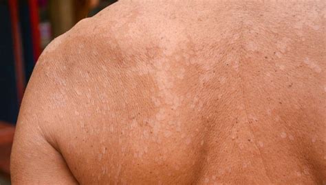 O Que E Pano Branco No Corpo - Pano branco na pele é contagioso? Como tratar a pitiríase versicolor ...