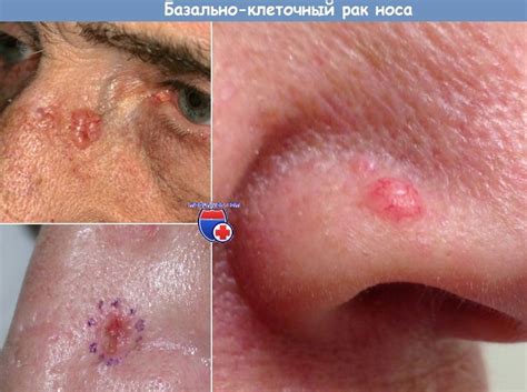 Симптомы базально-клеточного рака носа и его лечение