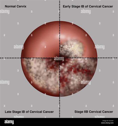 cervical cancer cervical cancer symptoms rzdnz
