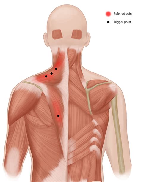Trigger Point Injection | Myofascial Pain Treatment | Pain Spa, Bristol, UK