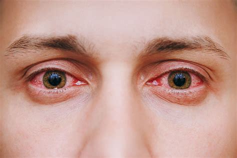 Pollen Allergy Eyes